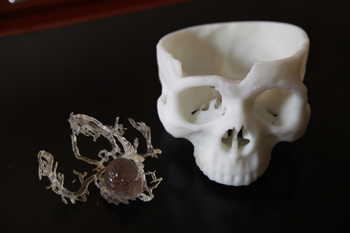 湘雅医院使用3D打印技术辅助切除肿瘤 高难度