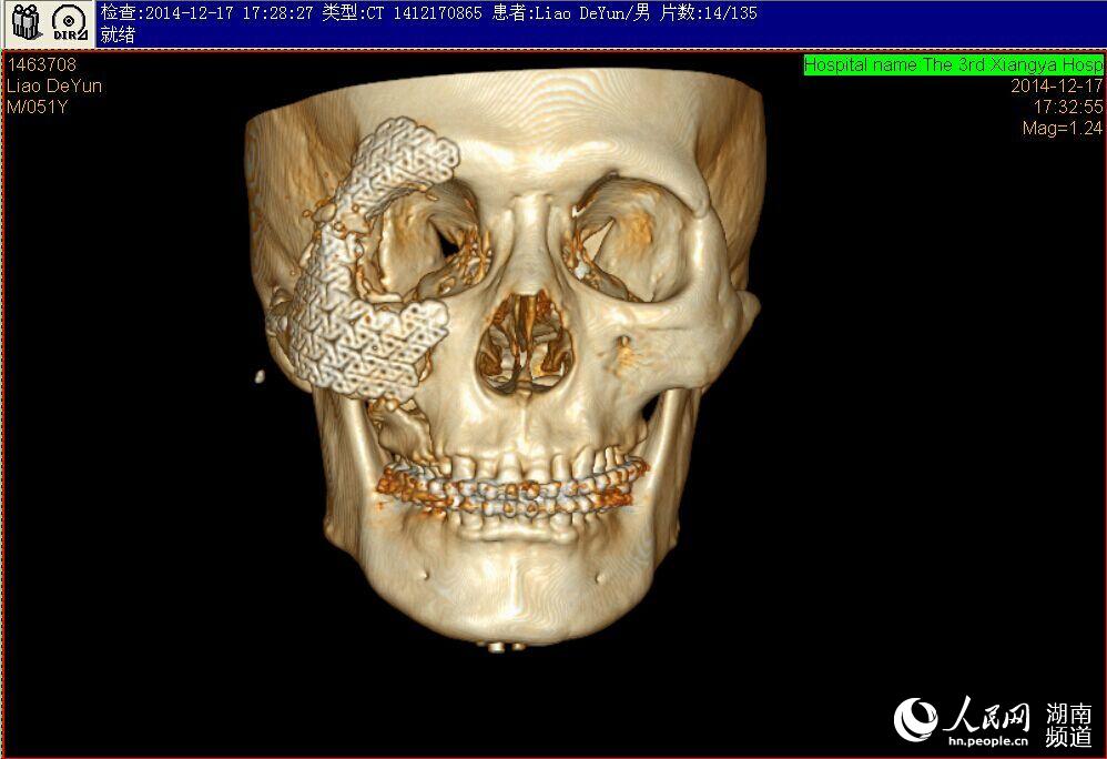 湖南省首例3D打印技术应用于口腔颌面部手术