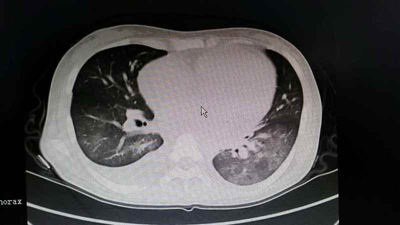 术前CT提示左心房、左心室增大,考虑左心功能