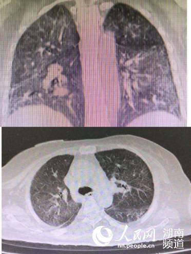 5月22日复查肺部CT显示：肺部病变较前明显吸收改善。田晶晶 摄