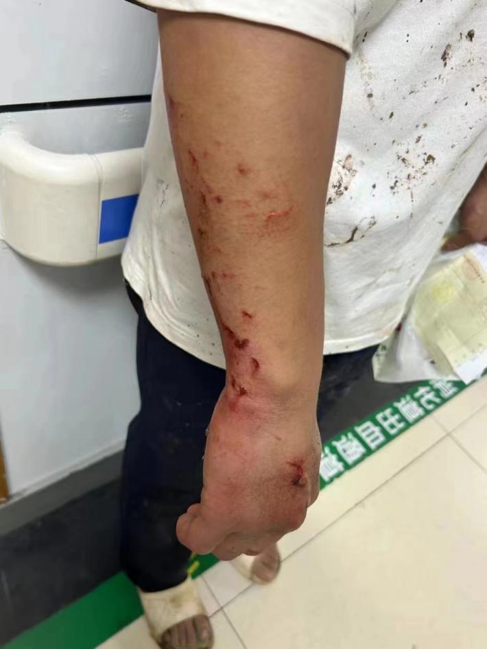 徒手砸車窗后，張含的手上留下一道道傷痕。 雨花區委宣傳部供圖